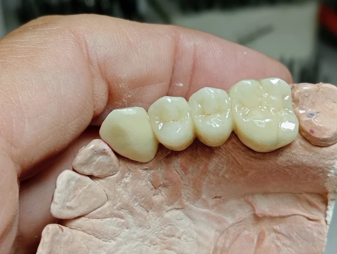 Puente de coronas dentales fabricado por Marsadent